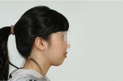 입술돌출 해소를 위해 내원하신 경우