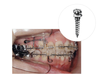 교정용 Mini-implant를 이용한<br>Mechanism의 간단화